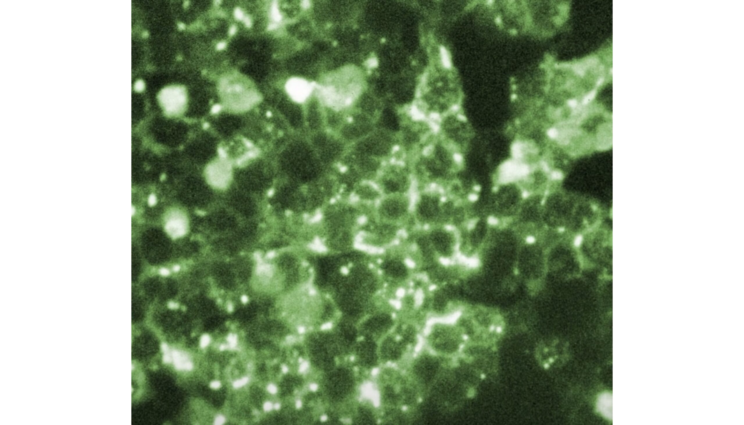How Rare Are Measles Deaths in the U.S. as Rates Fall?
